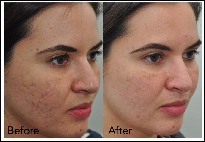 Лазерная шлифовка лица до и после. Демодекоз (угревая железница). Омолаживающий крем до после. Газожидкостный пилинг до и после. Лазерная шлифовка лица акне.