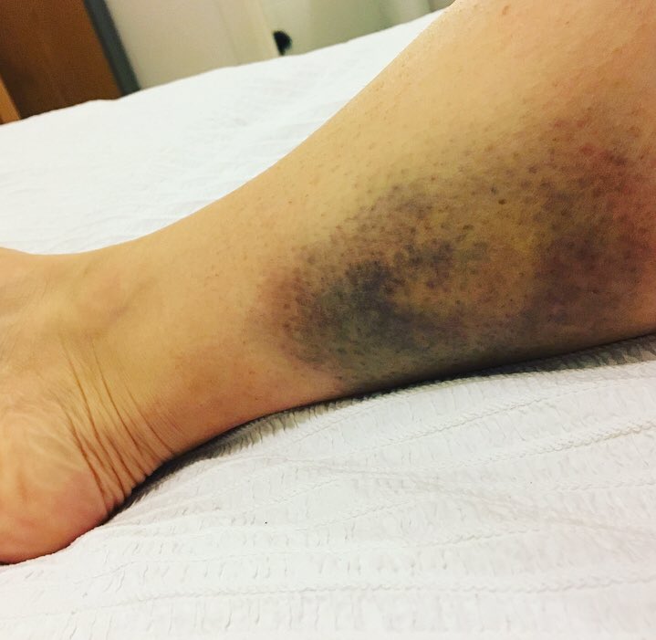 drumblonde1's tweet photo. Gotta love a hockey bruise. My own fault as over rotated but goalies love a bruise selection @obohockey https://t.co/w9vQc1O1VI