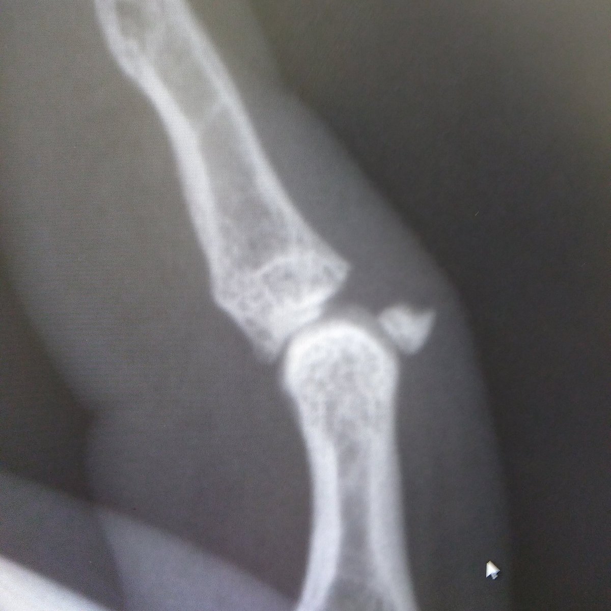 ChuckMcGhee's tweet photo. This isn't what I needed with all the presents I am planning to make. Got original diagnosis Saturday, but confirmed it at the orthopedic center today. My pinky is broken, and will require surgery to fix it. I meet with the surgeon Monday. https://t.co/Lojl6jV6Aa