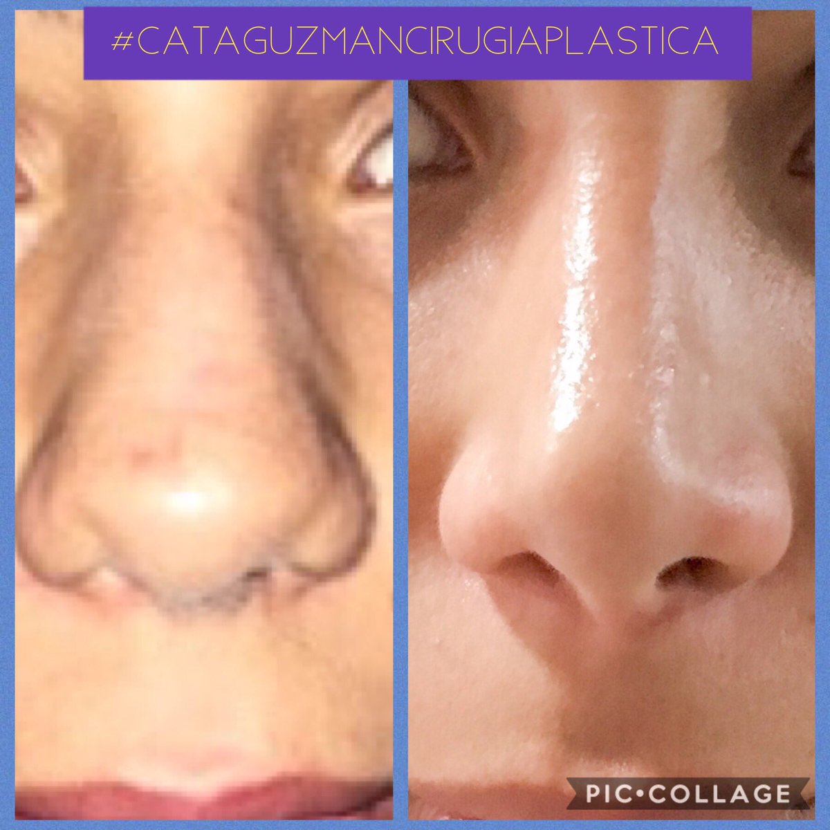 CxPlasticaCGD's tweet photo. La mejor rinoplastia es la que no se nota. 
Contáctame: Bogota 6164793. Villavicencio 3044743071. Email catamd50@hotmail.com
#RinoplastiaBogota #RinoplastiaColombia 
#RinoplastiaVillavicencio https://t.co/UILjvWxy7B