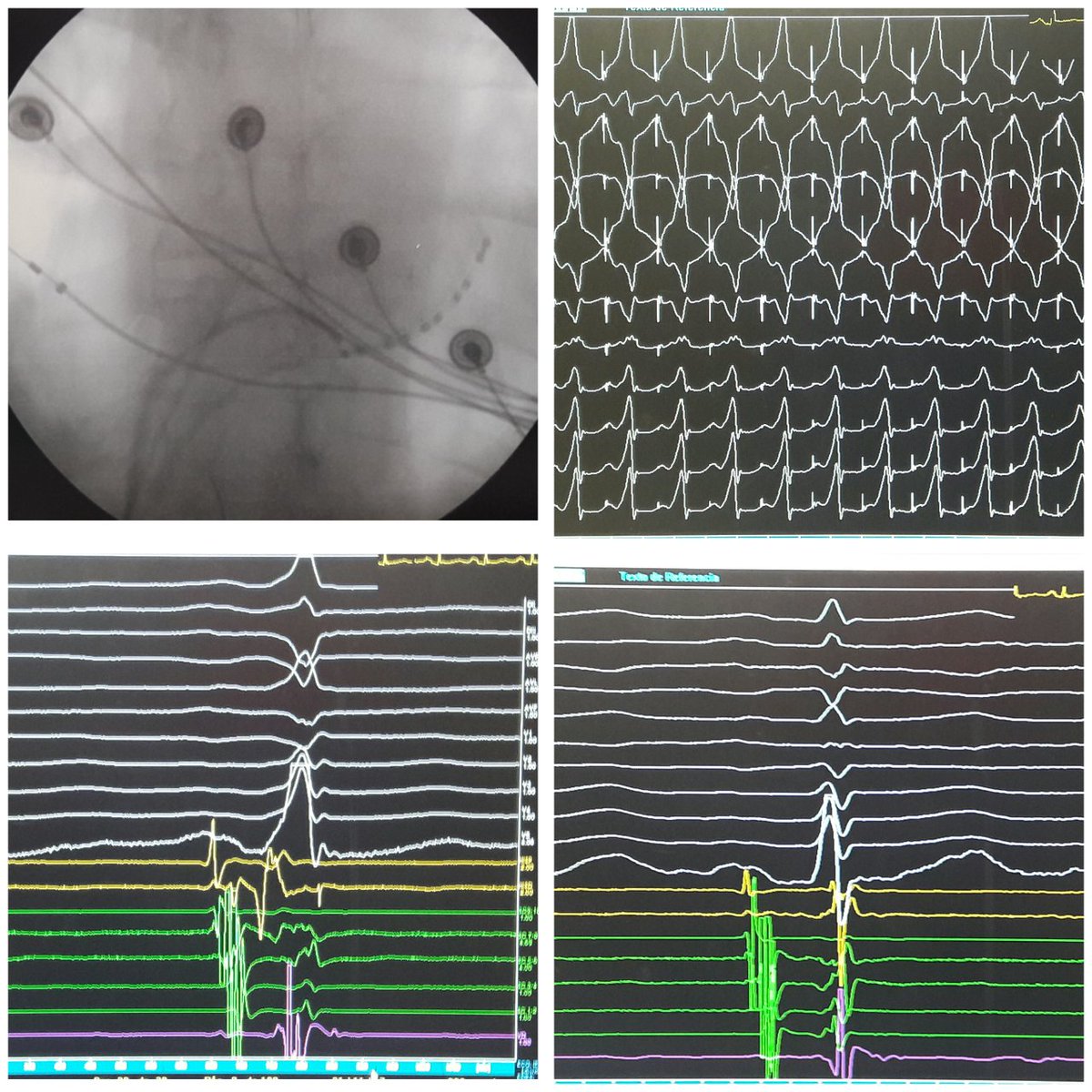 ALFIEEP1's tweet photo. #WPW #EPeeps #WPWeek. First of 4 WPW of the week. PS AP. Bermudas triangle. Map Tricuspid ring, cs and branches, transseptaly. Not so early anywhere. Finaly, the best spot at Tricuspid valve. -10 delta-ECG.
So..this zone; map, map , map. @SchakrabartiEP https://t.co/fmHwJkkwrX