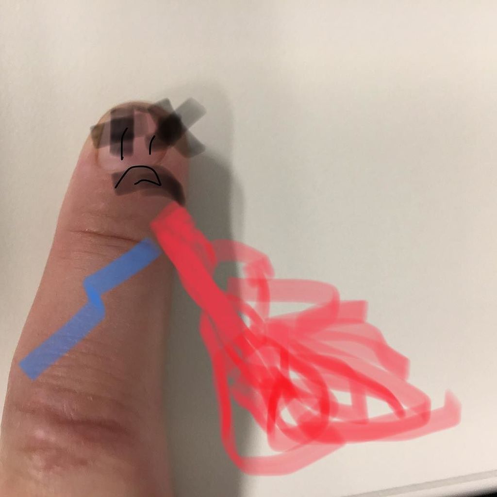 miss_olive47's tweet image. I mashed my finger up today. I think it has a concussion. #fingerinjury #itsserious #losangeles #california #concussion ift.tt/2hJFP8J