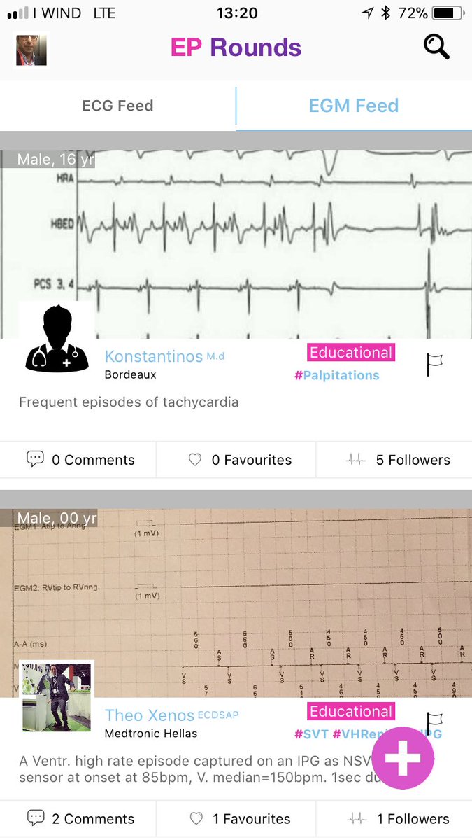 sozi81's tweet photo. #eprounds new case added. #cardioed #electrophysiology #svt @SchakrabartiEP @FredWuMD https://t.co/8qXuUE7VeB