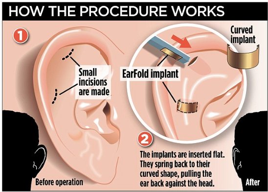Why have an otoplasty or better known as ear pinning surgery? bit.ly/2gdwIjC
