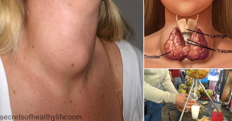 SecHealthyLife's tweet photo. Perfect Cure For The Thyroid And With Just 1 Item! https://t.co/AAXsg7zHdx https://t.co/UG1lGHLY7N