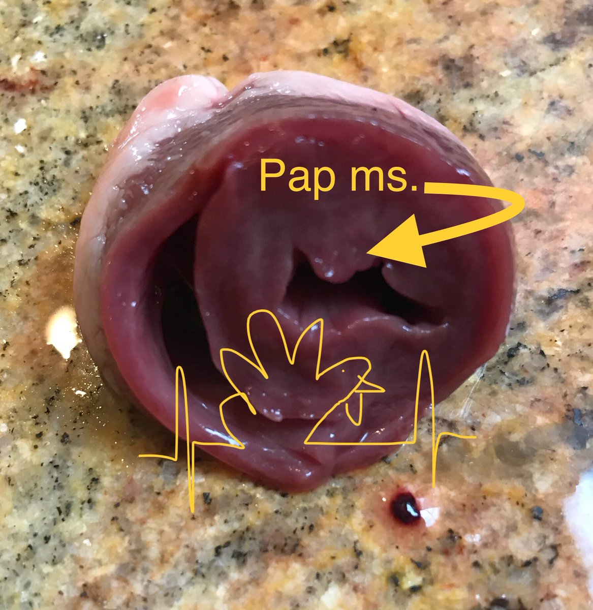 Christian Yacono (@cardpac79) on Twitter photo Was preparing the bird for brining and look what I found—HRS abstract for translational research purposes? <a href="/CMTschabrunn/">Cory M. Tschabrunn</a> Was preparing the bird for brining and look what I found—HRS abstract for translational research purposes? <a href="/CMTschabrunn/">Cory M. Tschabrunn</a>