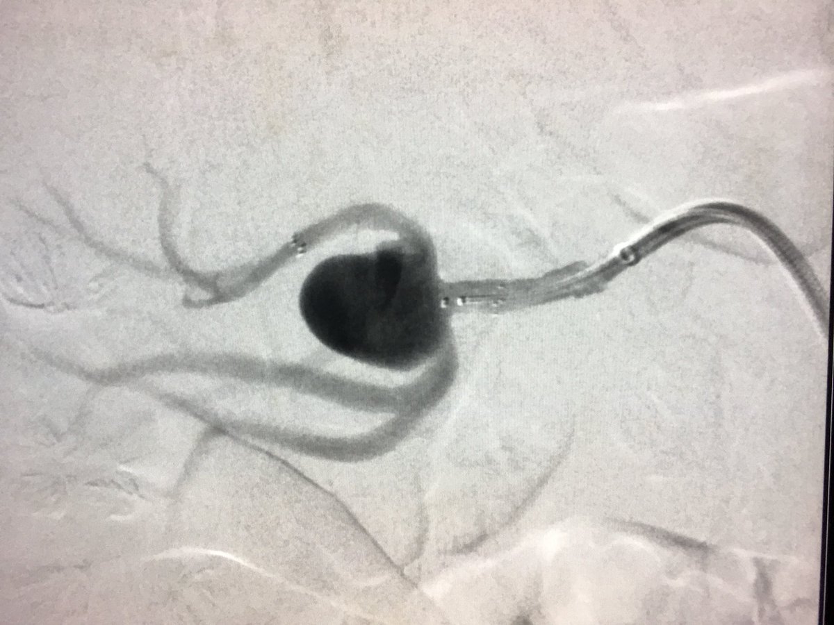 kstadt911's tweet photo. Renal artery aneurysm outpatient treatment with stent assisted coiling @CleveClinicFL preserving all branches renal artery #nephronsparing #IRad #withoutascalpel https://t.co/hbWAdvlmQ4