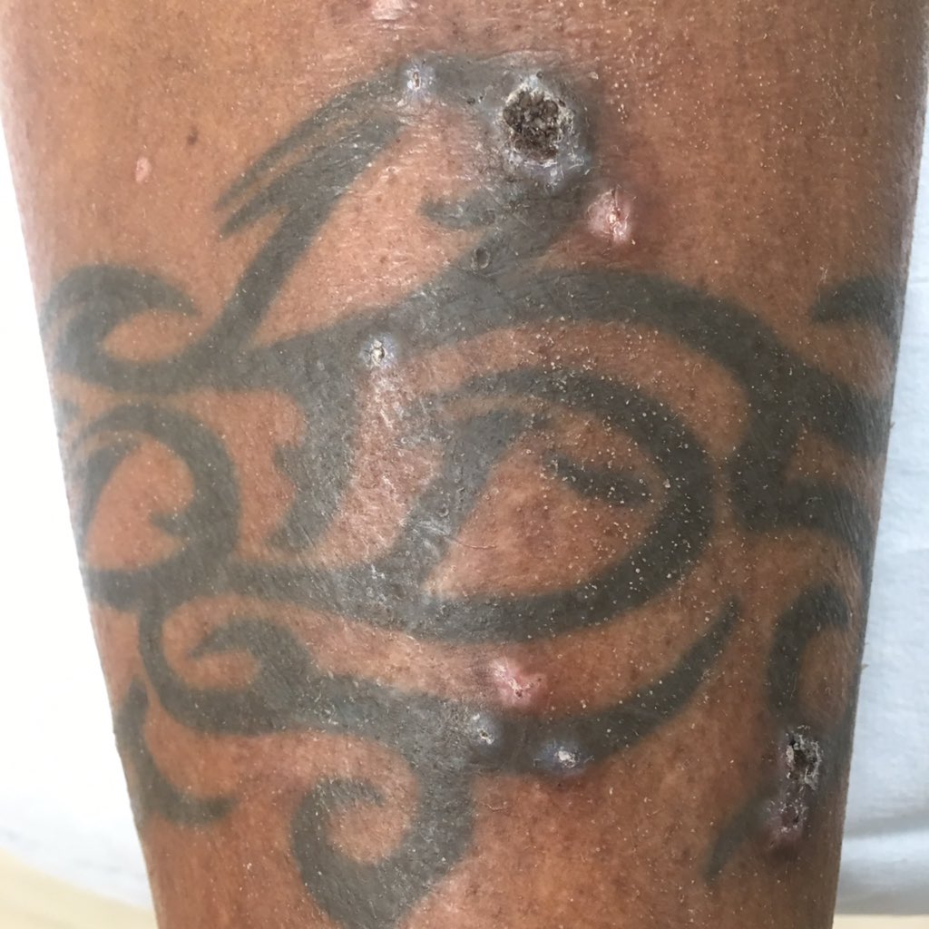 Dr. Marie Leger on Twitter: "If your black #tattoo is bumpy have your #dermatologist evaluate you for sarcoidosis! We can help. @WeillCornell https://t.co/l1gTxYCdK8" / X