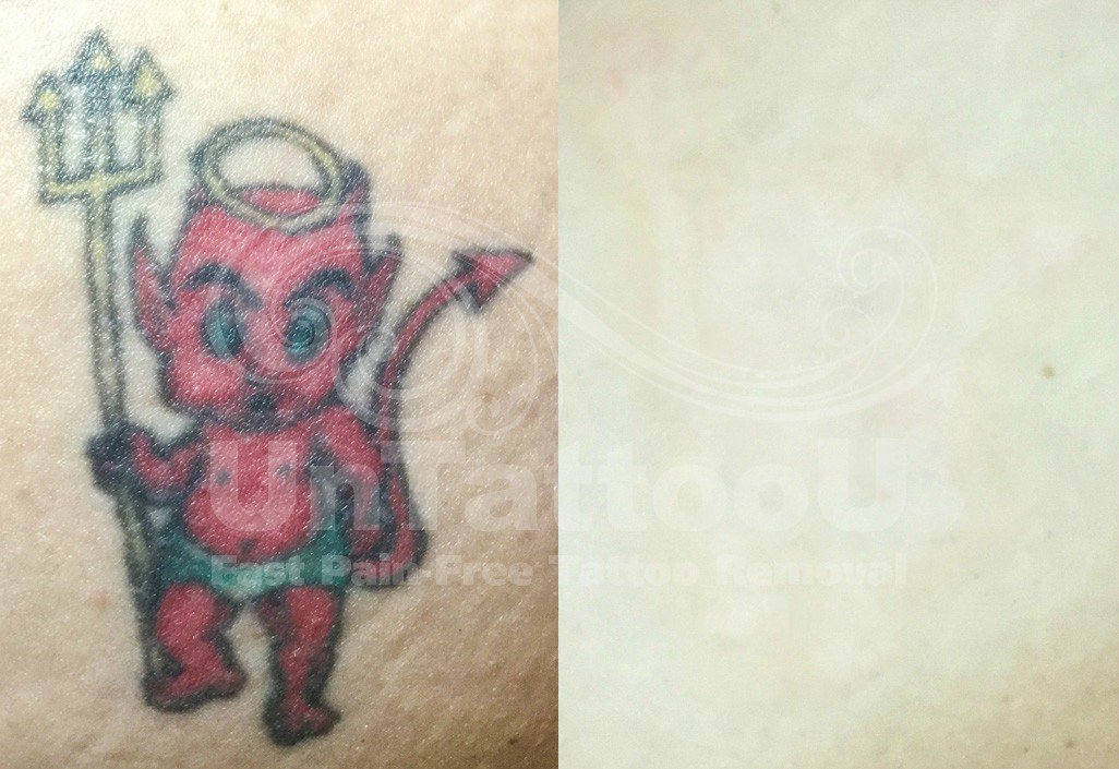 UntattooU's tweet photo. After just only 6 TX's w/ #PicoSure this tattoo is gone! Our expert staff of nurses are able to achieve great clearance on all #ink colors, faster than ever before!
#lasertattooremoval #tattooremovalspecialists #tattoos #inked #nothingisforever #inkregret #bodyart #tattooedlife https://t.co/IiEYV75v8t