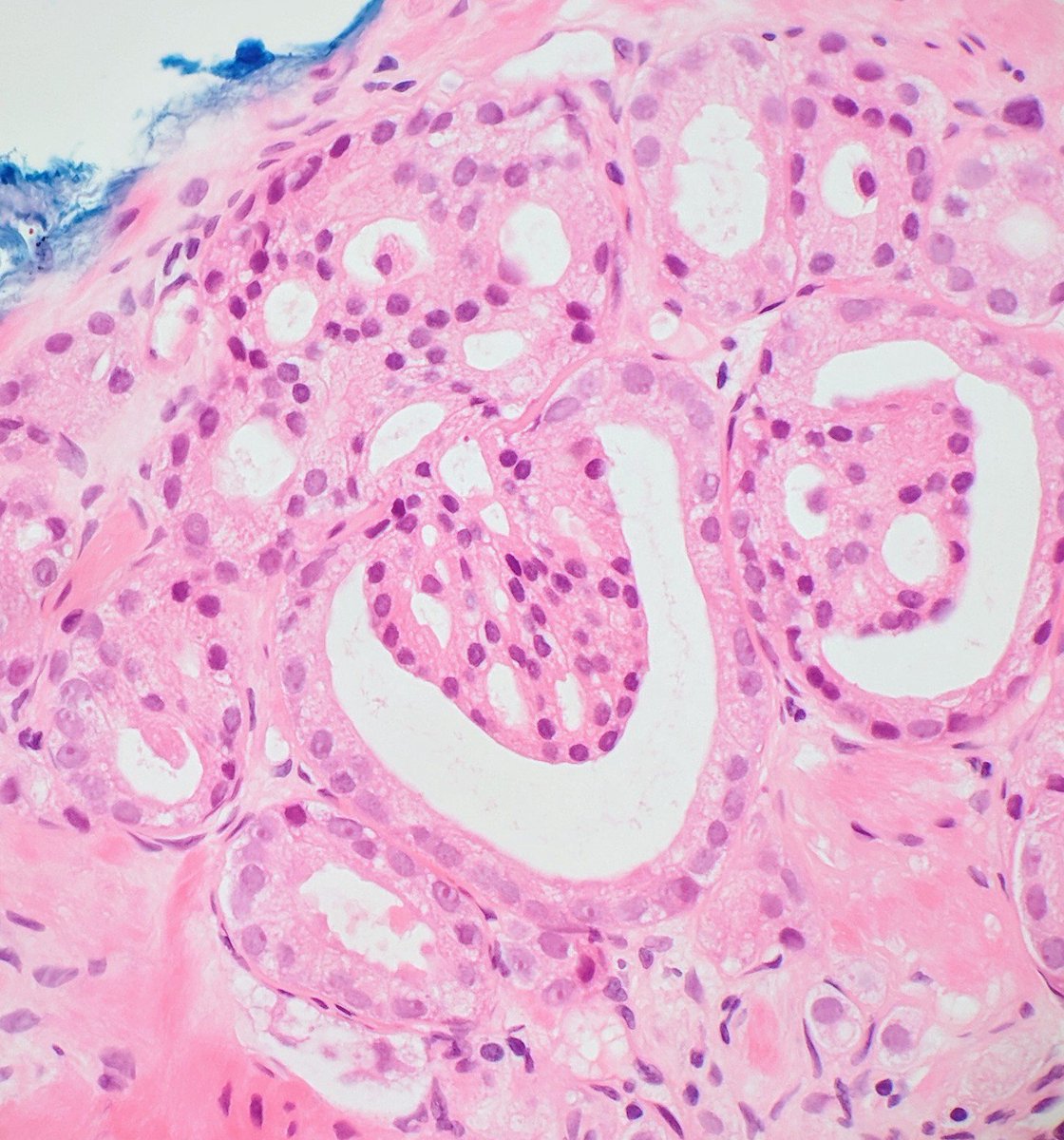This is so 'glomeruloid' that it's even trying to mimic afferent/efferent vessels #gupath #prostatecancer #grade4