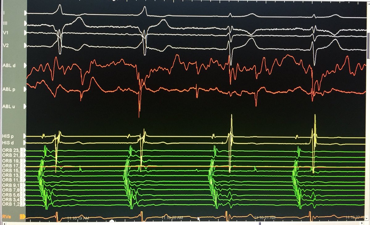 xaviertorresmd's tweet photo. Accessory pathway, good ablation catheter positioning #wpweek https://t.co/5KwbRgDnSl