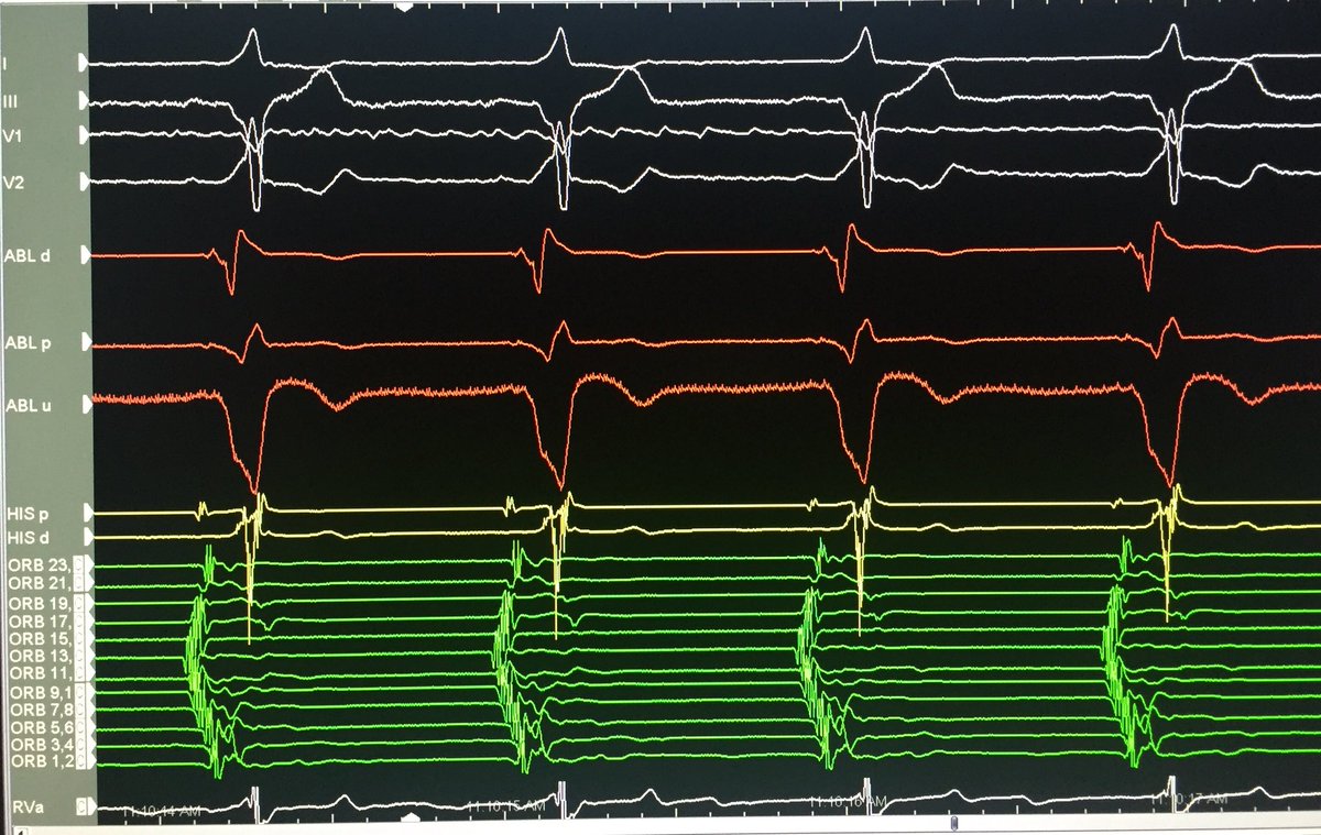 xaviertorresmd's tweet photo. Accessory pathway, good ablation catheter positioning #wpweek https://t.co/5KwbRgDnSl