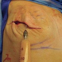 prsjournal's tweet photo. Top-Viewed in #PRSJournal: Prepectoral Breast Reconstruction https://t.co/OnE4il6IX6 #Plasticsurgery https://t.co/QU4jNJHUtw