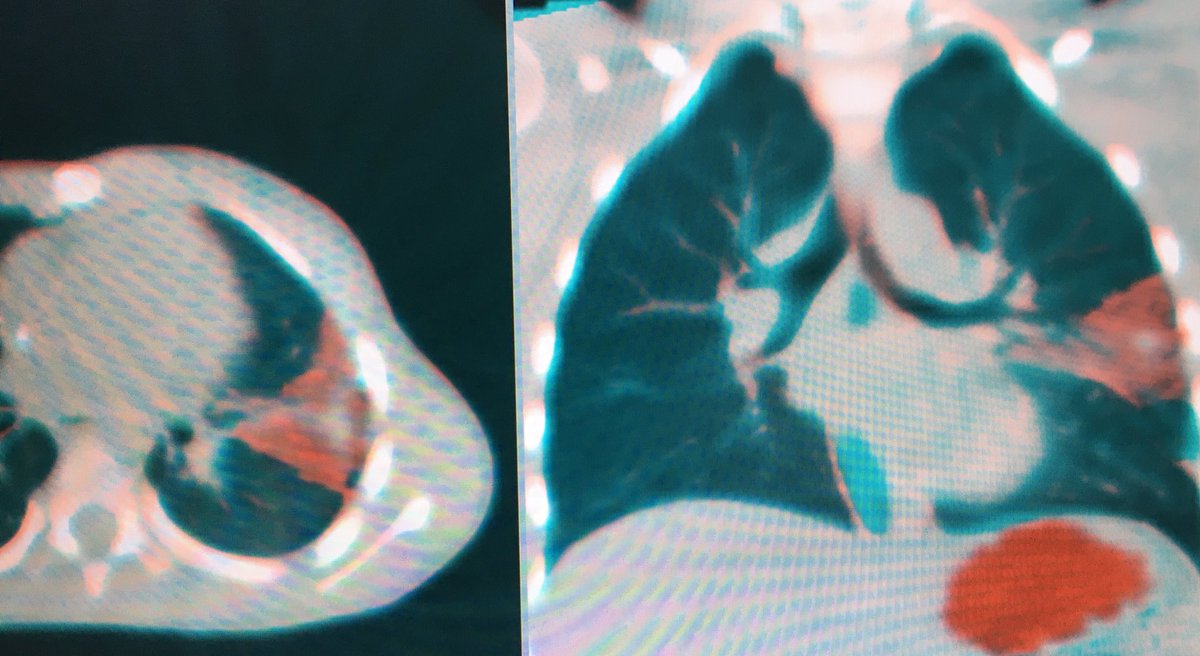 fermgmez's tweet photo. Really helpful image overlay on #XPerCT and #XPerGuide ablation after alveolar haemorrhage during lung mets ablation @PhilipsHealth https://t.co/gnhUIPxE7K