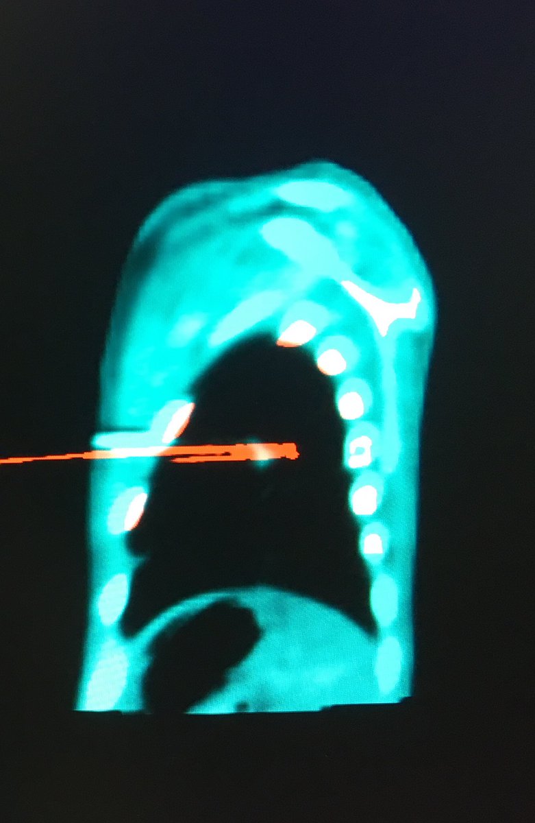 fermgmez's tweet photo. Really helpful image overlay on #XPerCT and #XPerGuide ablation after alveolar haemorrhage during lung mets ablation @PhilipsHealth https://t.co/gnhUIPxE7K