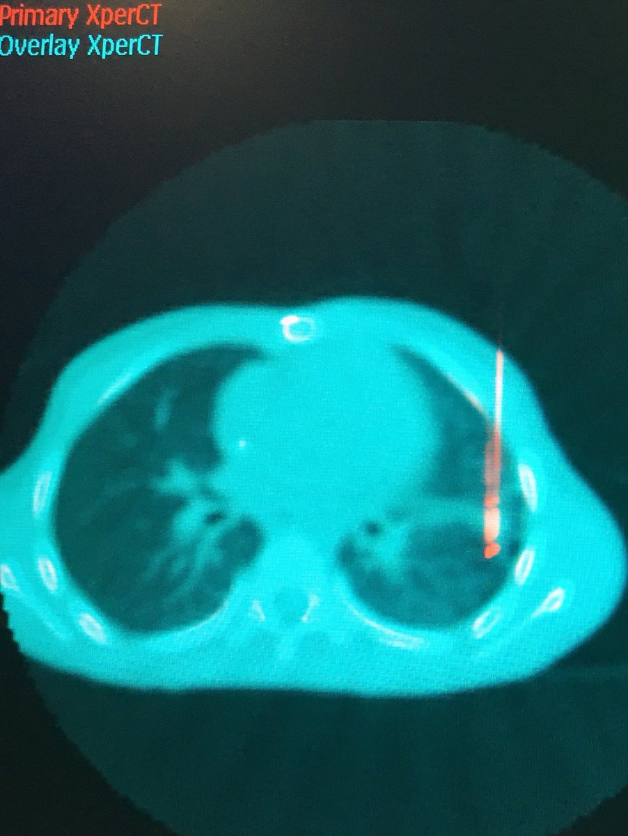 fermgmez's tweet photo. Really helpful image overlay on #XPerCT and #XPerGuide ablation after alveolar haemorrhage during lung mets ablation @PhilipsHealth https://t.co/gnhUIPxE7K