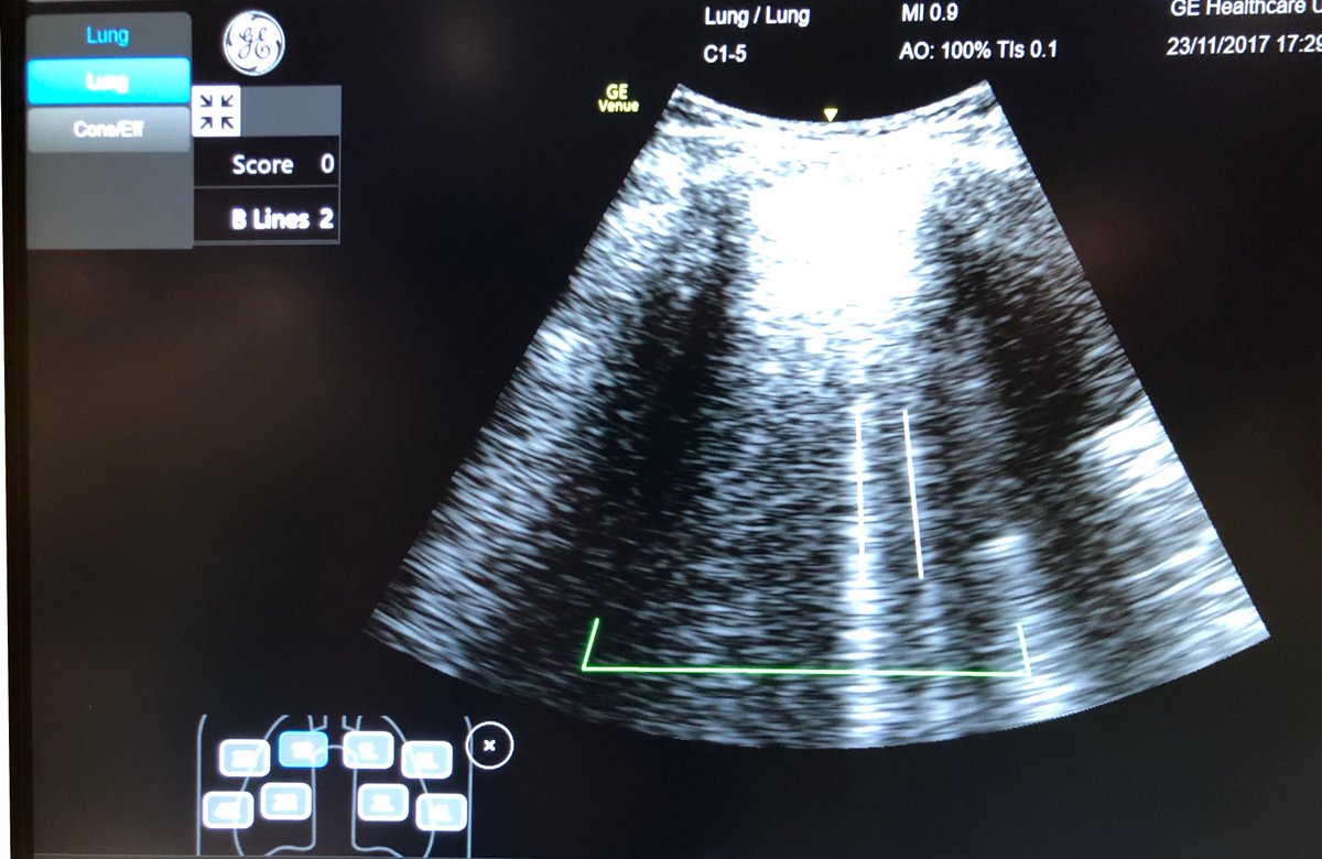 PARADicmSHIFT's tweet photo. My #POCUS model at #IFAD2017 drank >3000mL of water!
@GEHealthcare ‘s new Venue and it’s Auto B-Line function works nicely!
What a trooper!
#FOAMed #FOAMus #FOAMcc https://t.co/bBb6gzcfZz
