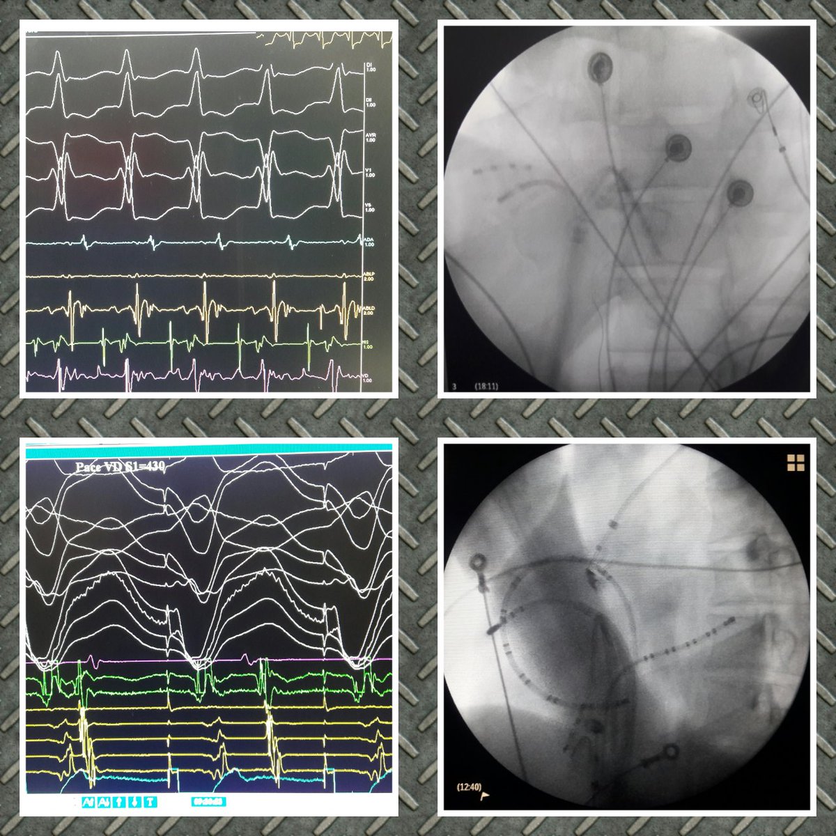 ALFIEEP1's tweet photo. #EPeeps #WPWeek unbelieveble. 2 pt with right free wall AP in the same day. Same approach with Agilis https://t.co/a3B3T0vgTR