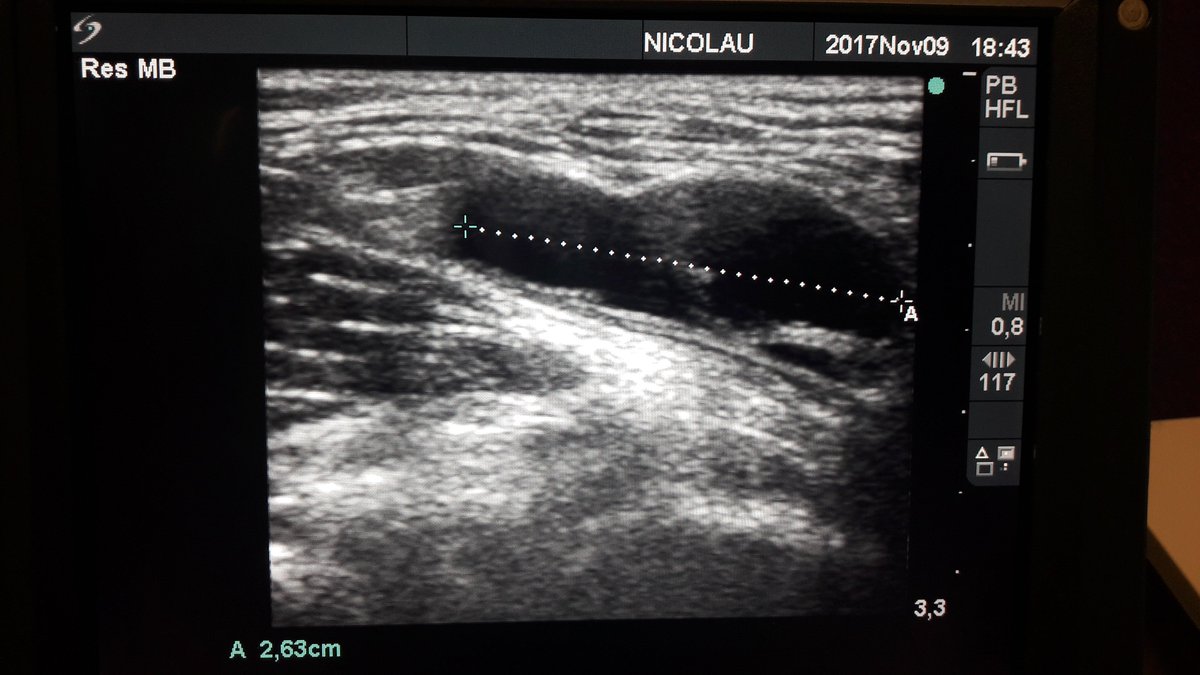 FDNCCC's tweet photo. Reabsorción de un Quiste de Baker en un jugador de fútbol por excesiva tensión en cadena muscular posterior 👌 https://t.co/reXynPOV2g