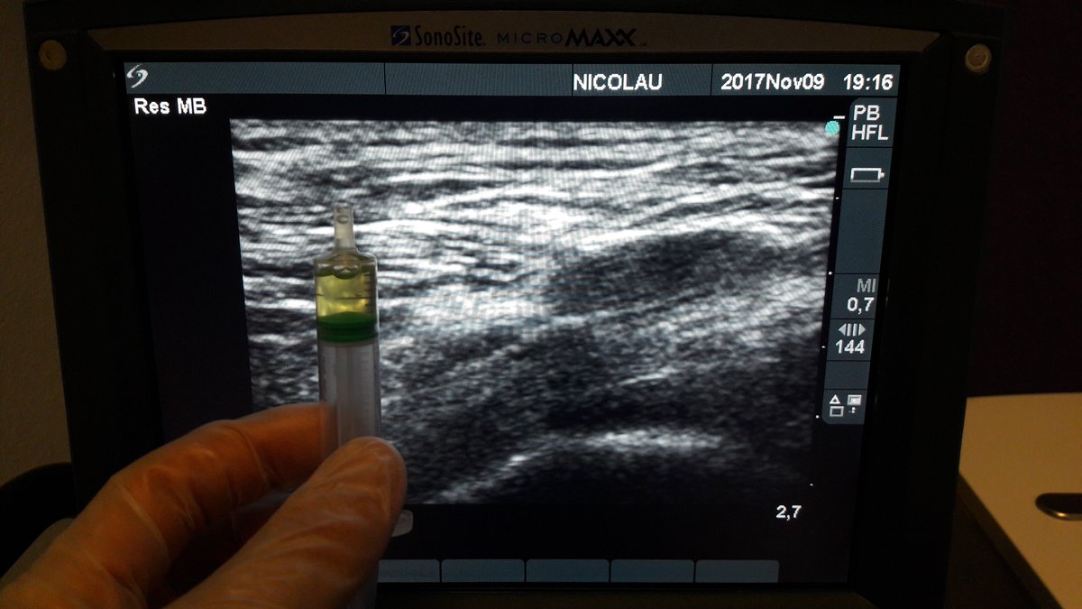 FDNCCC's tweet photo. Reabsorción de un Quiste de Baker en un jugador de fútbol por excesiva tensión en cadena muscular posterior 👌 https://t.co/reXynPOV2g