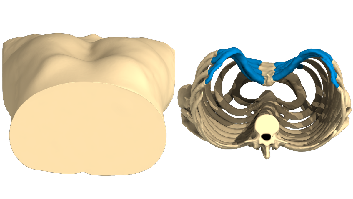 AnatomikM's tweet photo. Pectus Excavatum case of the week.
Male deep symmetric Pectus Excavatum. 
3D virtual patient's body reconstruction to design #3D custom-made implant. #pectus #pectusexcavatum #MedicalDevices #thoraxsurgery https://t.co/KOJ0ofxAKL