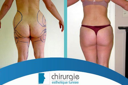 clinique_tunis's tweet photo. La #liposuccion des #hanches englobe plusieurs zones telles que les poignées d'amour ou la culotte de cheval : infos et prix sur :https://t.co/fgKnJr2eOP https://t.co/myEZJbSfhy