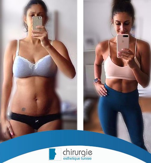 clinique_tunis's tweet photo. sculptez votre #corps sans effort , remplissez les creux et mettez en valeur vos formes pour une #silhouette plu #sexy. La #liposculpture associe #liposuccion douce et #lipofilling afin de traiter la #silhouette. 
Plus de détails sur 
https://t.co/fgKnJr2eOP https://t.co/wftcEmZCjT