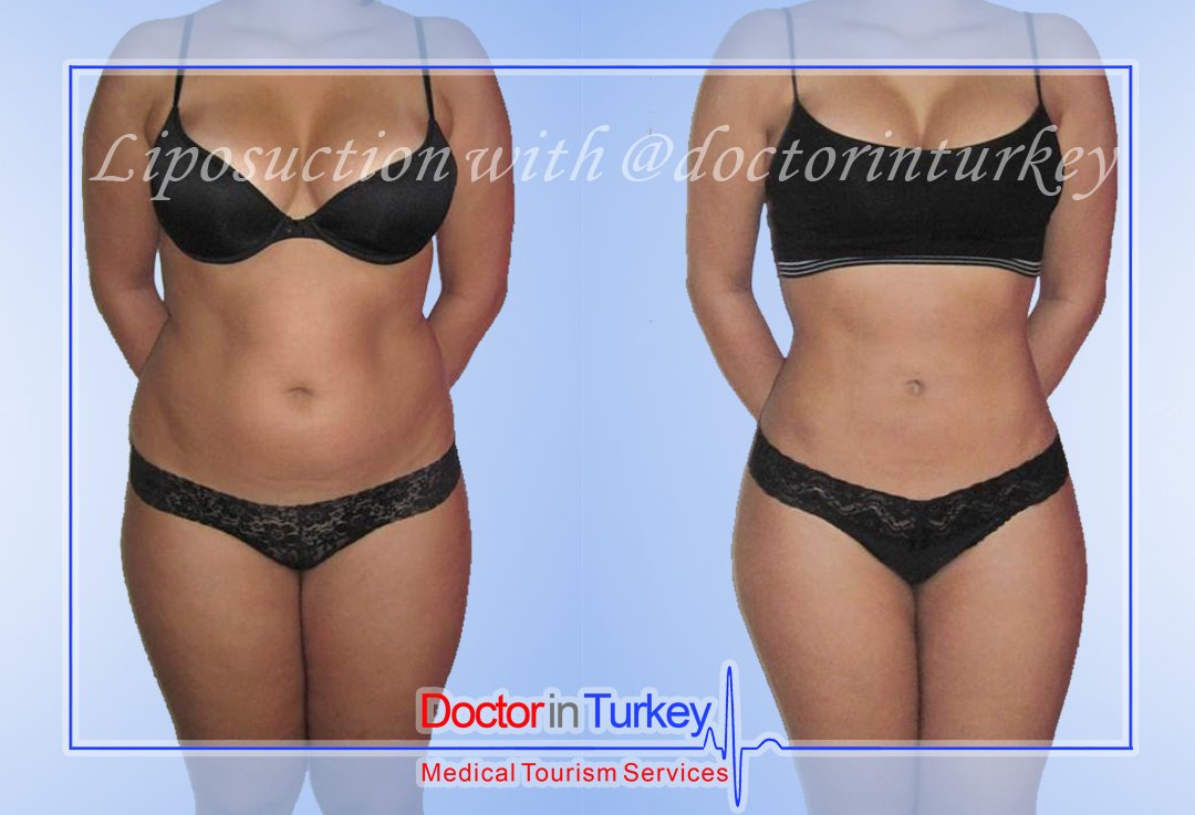 medigance's tweet photo. For the best treatment, we choose the Premium Quality Hospitals for you 🏥
#doctorinturkey now has 78 big hospitals in database. 📝
#plasticsurgery #liposuction #lipo #dermalfillers #botox #tommytuck #surgeryinturkey https://t.co/K9NMDxqb8W