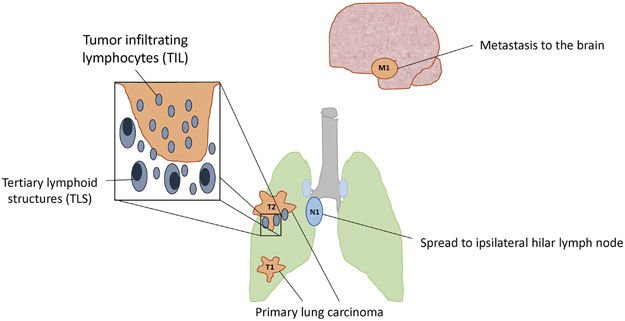 Anirban Maitra (@aiims1742) on Twitter photo #Pathologists Must read review on the tumor immune microenvironment for staging & therapeutics
By two of my favorite <a href="/JHUPath/">Johns Hopkins Pathology</a> faculty stars Ashley Cimino-Mathews & Janis Taube
nature.com/articles/modpa…
Someday immune parameter assessment will be part of TNM classification #Pathologists Must read review on the tumor immune microenvironment for staging & therapeutics
By two of my favorite <a href="/JHUPath/">Johns Hopkins Pathology</a> faculty stars Ashley Cimino-Mathews & Janis Taube
nature.com/articles/modpa…
Someday immune parameter assessment will be part of TNM classification