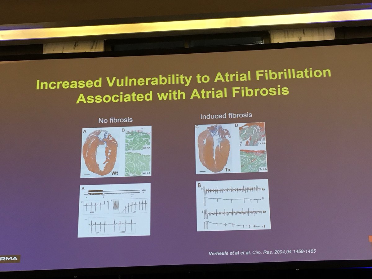 stopafib's tweet photo. RT @DebbeMcCall: ⬆️ vulnerability to #Afib associated with atrial fibrosis  @nmarrouche #CVCT17 #CVCTforum https://t.co/N5FJ8KovkS