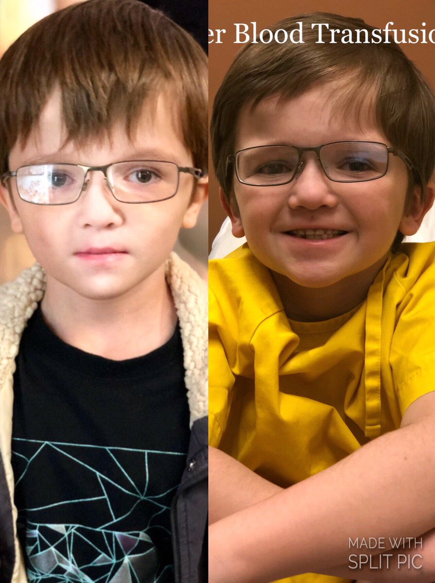 DBAJourney's tweet photo. #CUREDBA I had my #BloodTransfusion yesterday at #AlbertaChildrensHospital what a difference 1 blood transfusion can make #DBAStrong #DiamondBlackfanAnemia https://t.co/RDLlXrxmiG