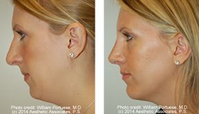 Implantech's tweet photo. Look at the stunning results after a chin implant from Dr. William Portuese. #plasticsurgeon #plasticsurgery #surgery #implantech #implants #chimplants #chinimplant #drportuese #williamportuese  #billportuese #facialimplants https://t.co/PkY45Yk3Ha