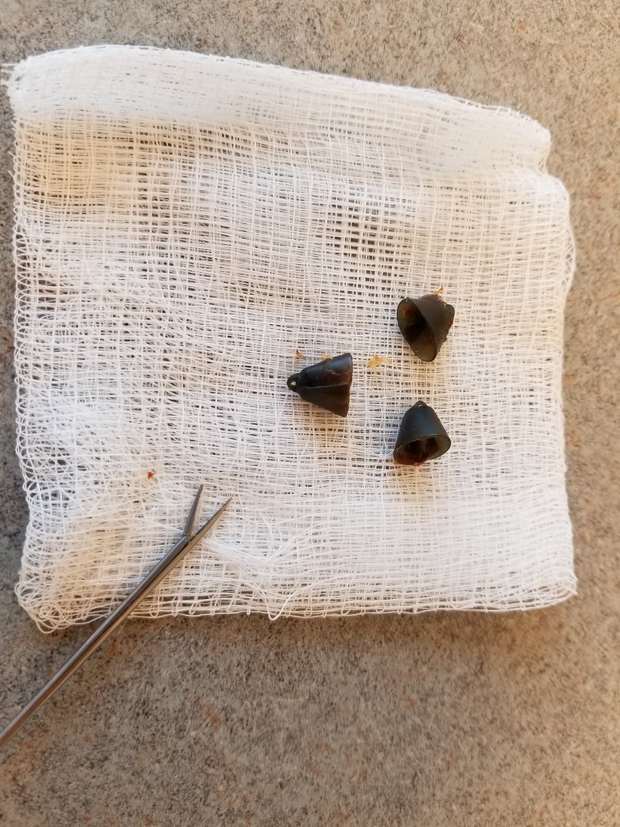 BianaLanson's tweet photo. This morning, #suddenhearingloss was easy to treat. All 3 hearing aid domes were pulled out from same pt! #happypt #lovemyjob @stamfordENT @zeitlereardoc @AAOHNS https://t.co/V984tiA8P1