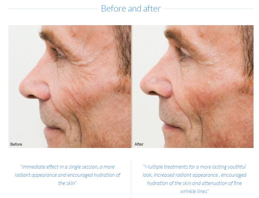 NovoSano's tweet photo. Immediate effect in a single session, a more radiant appearance and encouraged hydration of the skin with @CooLifting https://t.co/symQOVAUE1 #Cryotherapy #beforeandafter #Medspa https://t.co/CjzAy89Ocu