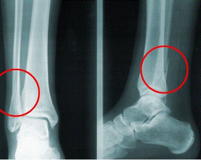 cprfourall's tweet photo. Pensaba que me había fracturado el peroné... pero no  #ByNadadorSupremo #Socorristas #FSSCV (ojo, en la imagen sí está fracturado) https://t.co/G2h489wtT8
