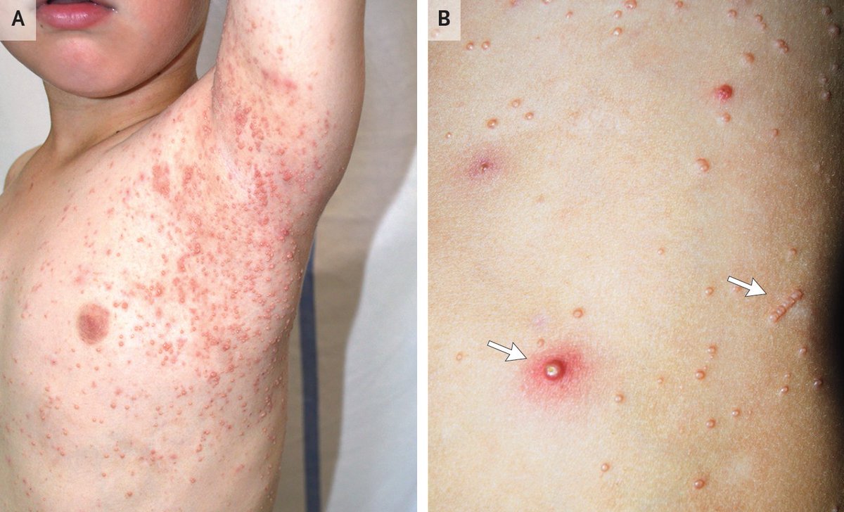Pictures - molluscum contagiosum Pictures - molluscum contagiosum