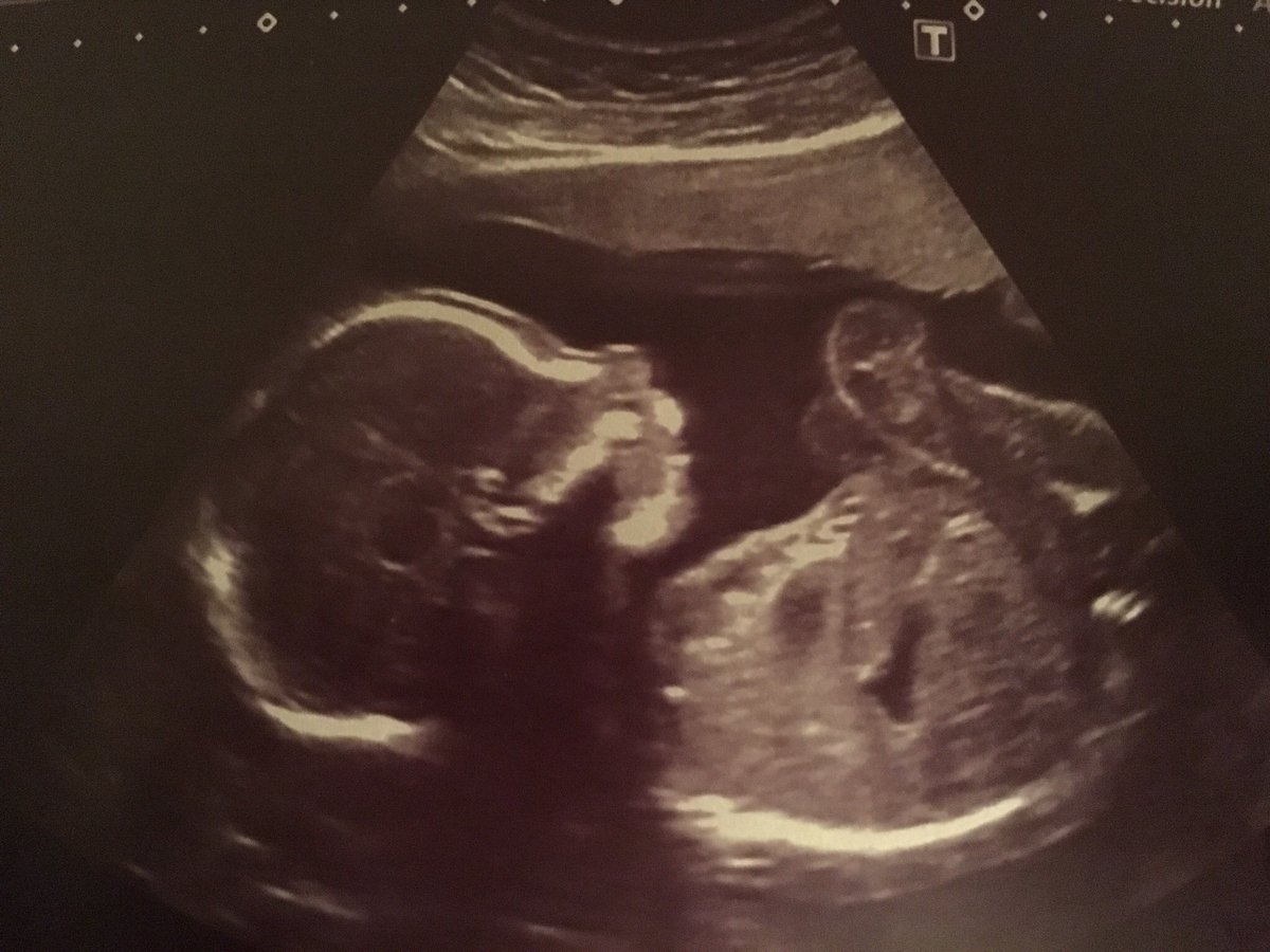 cameronwaghorn's tweet photo. Baby W is a Boy! #FutureAllBlack #Itsaboy 👶🏻🏉 https://t.co/rc1fGNFff0