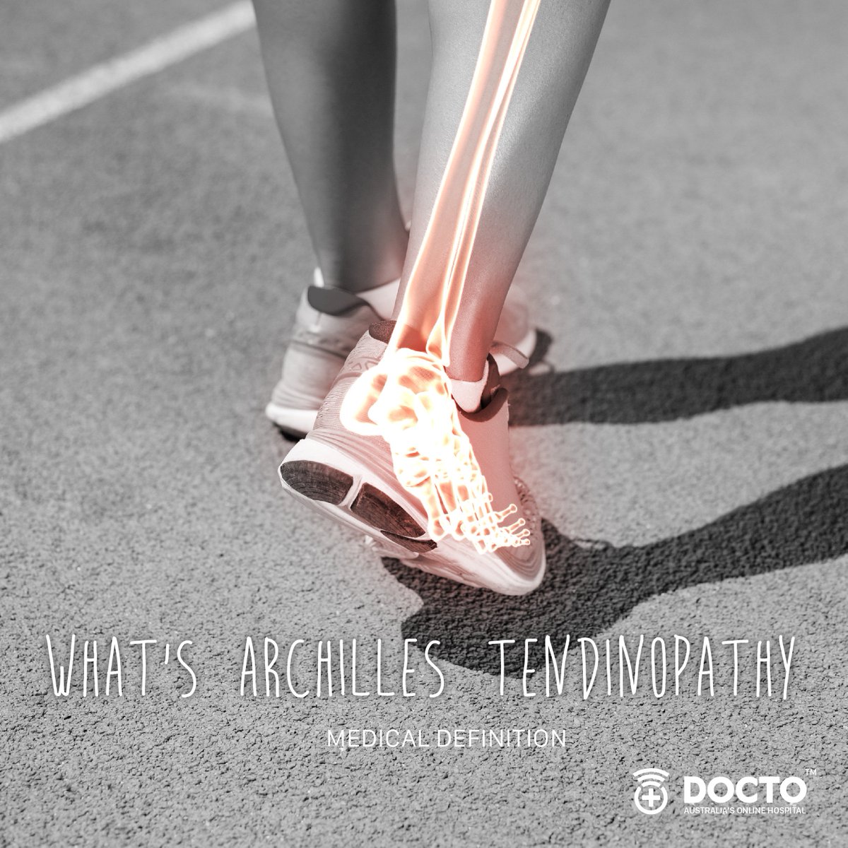docto247's tweet photo. Archilles Tendinopathy is a chronic, yet common condition in sports people and recreational athletes. All injuries should be checked and diagnosed professionally. See Dr now: https://t.co/8pPJfDG36R https://t.co/sh8xqIP6U3