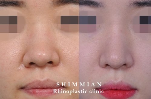 韓国シンミアン整形外科 公式 団子鼻の矯正 正面顔も横顔もナチュラル美人に Line Id Doctorhere 日本語通訳士在 シンミアン 団子鼻 鼻整形 韓国 美容整形 韓国美容 ゴアテックス 整形 韓国整形 T Co 3l3bpudstg Twitter 韓国シンミアン整形外科 公式 団子鼻の矯正 正面顔も横顔もナチュラル美人に Line Id Doctorhere 日本語通訳士在 シンミアン 団子鼻 鼻整形 韓国 美容整形 韓国美容 ゴアテックス 整形 韓国整形 T Co 3l3bpudstg Twitter