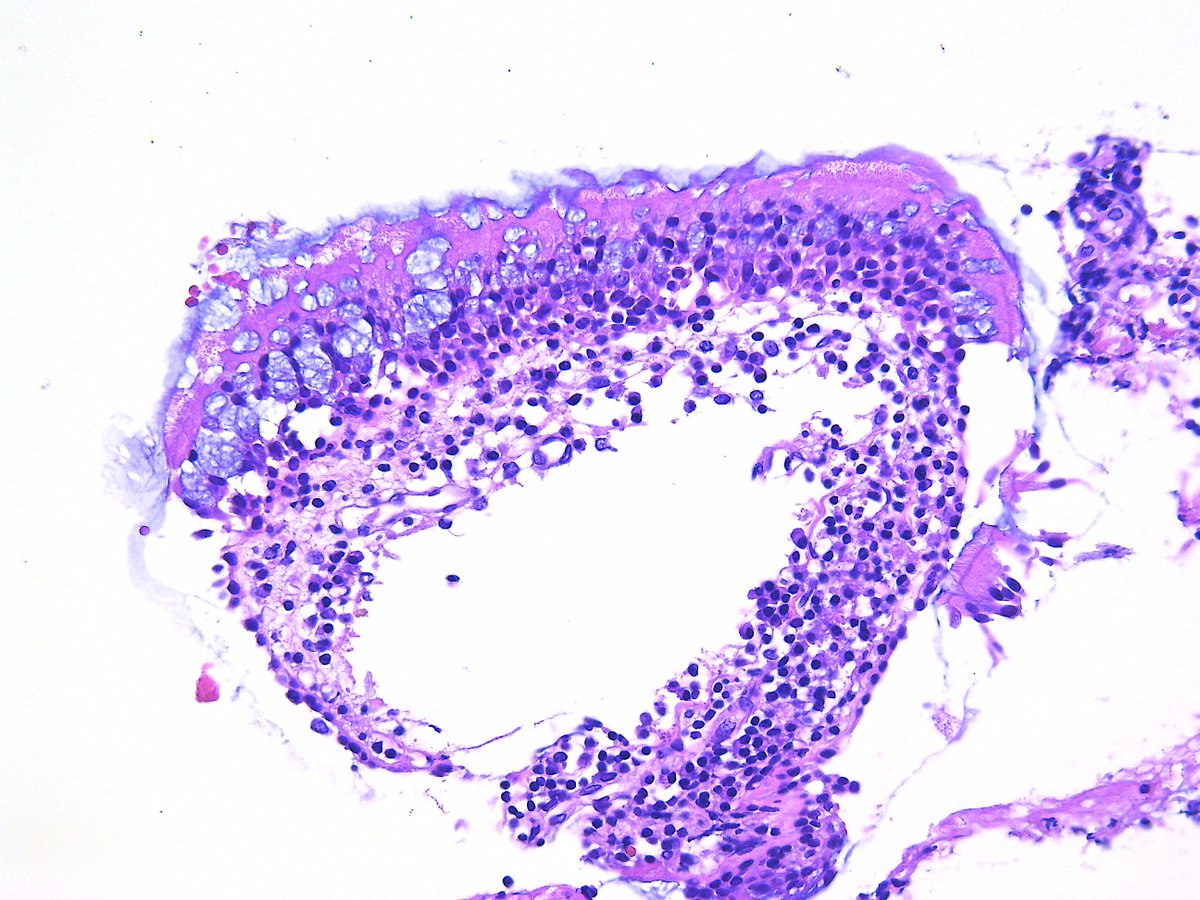 Patholwalker's tweet photo. Rathke's cleft cyst. Sellar lesion, excision. HE, CKAE1/AE3 and MRI(T2WI). https://t.co/kIeWZagwLe