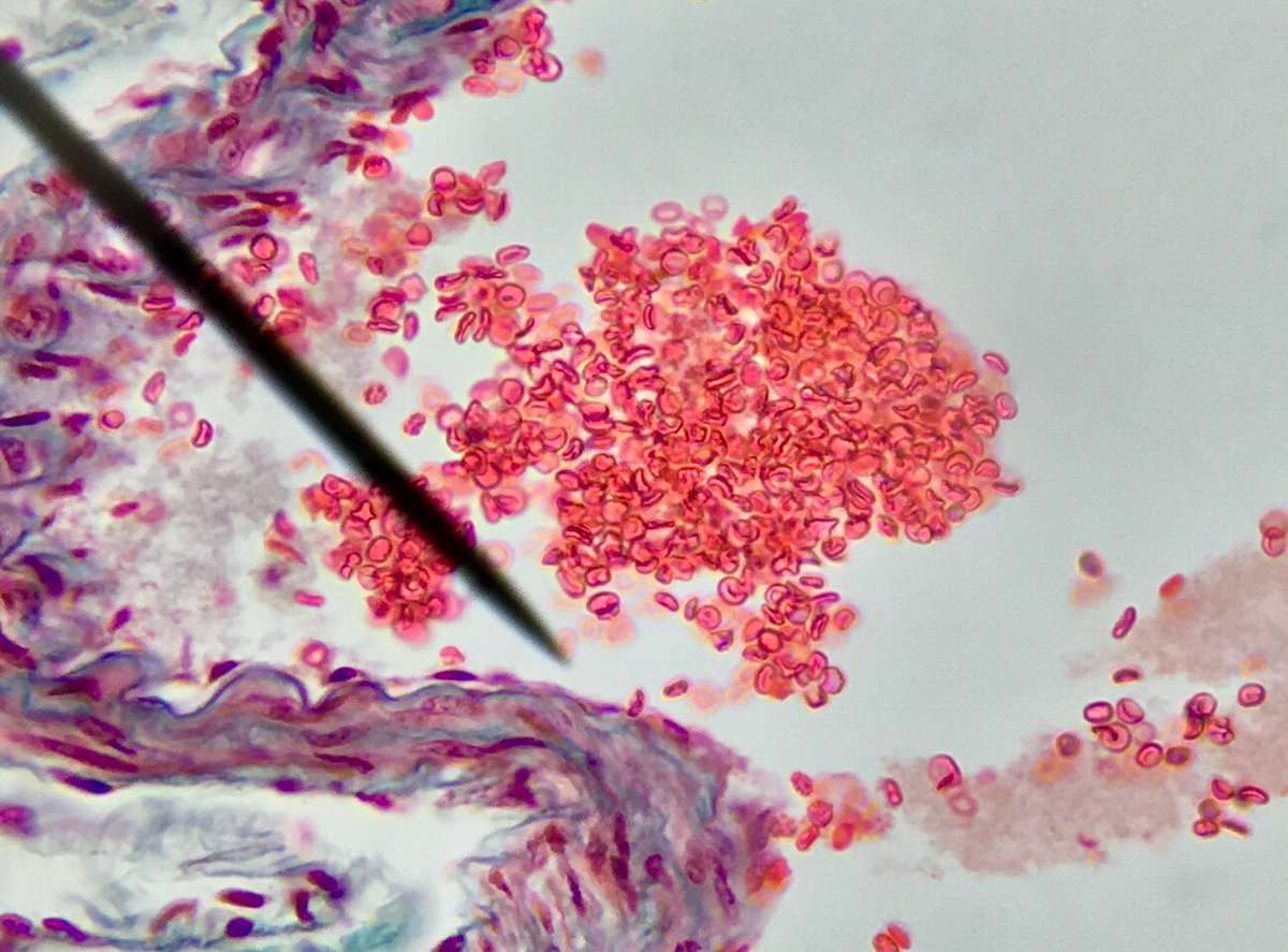 j11p43f's tweet photo. Beautiful lung transection under the microscope! Erythrocytes (red blood cells) showing their distinctive biconcave shape to increase surface area to volume ratio for oxygen diffusion, and flexibility to get through capillaries!
#MicroscopeScience #BiologyIsAmazing https://t.co/y7d7j9n72N