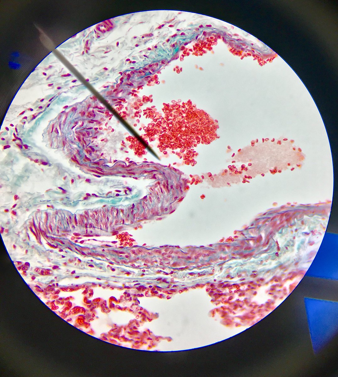 j11p43f's tweet photo. Beautiful lung transection under the microscope! Erythrocytes (red blood cells) showing their distinctive biconcave shape to increase surface area to volume ratio for oxygen diffusion, and flexibility to get through capillaries!
#MicroscopeScience #BiologyIsAmazing https://t.co/y7d7j9n72N