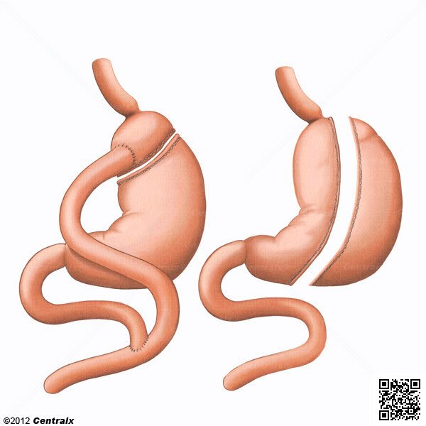 MyDoctor_App's tweet photo. ¿Conoces los riesgos de la #cirugía bariátrica? Indicaciones, técnicas, postoperatorio, especialistas con más experiencia, etc. 
#EligeEspecialistas y consulta todas tus dudas con los mejores #cirujanosgenerales en @MyDoctor_App https://t.co/G4cKOwkwbC