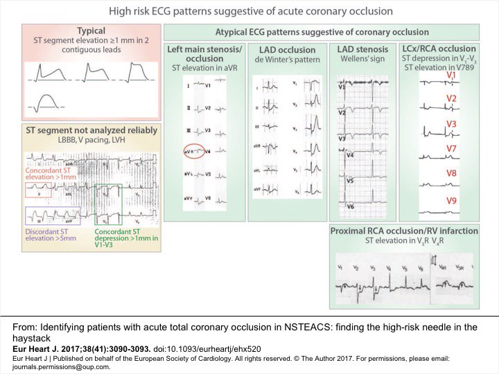Ph Gabriel Steg Some Ecg Patterns Can Help Identify Occluded Culprit Vessels In Nst Segment Elevation Acs T Co Snmpufouis Dlbhattmd Nstemi T Co Idpshdww0g