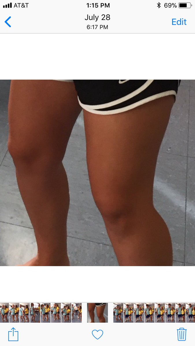 anna_niewald's tweet photo. look at this skin difference. i️ really don’t wanna talk ab it but i️ want you to see the pain that i’m going through right now https://t.co/0DORUOcIqX