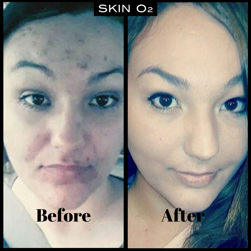 We work into your skin and give you the skin you've always wanted! Check our products: #SkinO2ME