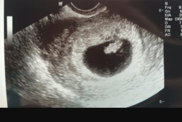 It's a miracle how one woman can make me the happiest man alive ❤
Number 7 is on his/her way.
<a href="/Beautiful_Esme7/">Esme Ann Cullen</a> I love you so much baby