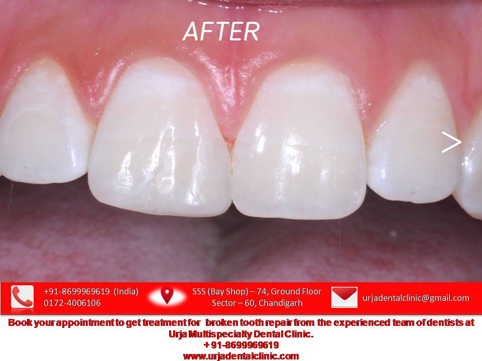 india_dental's tweet photo. #brokentoothrepair #toothrepair #crackedtoothrepair #fixchippedtooth #chippedtoothrepaircost
+91-8699969619
https://t.co/nUaJgp5tZo
email id: urjadentalclinic@gmail.com https://t.co/XQLBMYE0uC