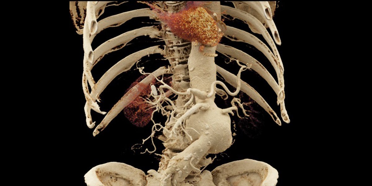 "The combination of #deeplearning, NVIDIA GPU computing &amp; medical imaging is spurring a new age of intelligent medical instruments." More via <a href="/kpowgerade/">Kimberly Powell</a>: nvda.ws/2joaZ6g #RSNA17