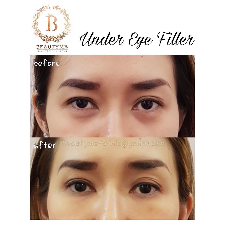 Beautyme Clinic On Twitter Under Eye Filler Untuk Mengatasi